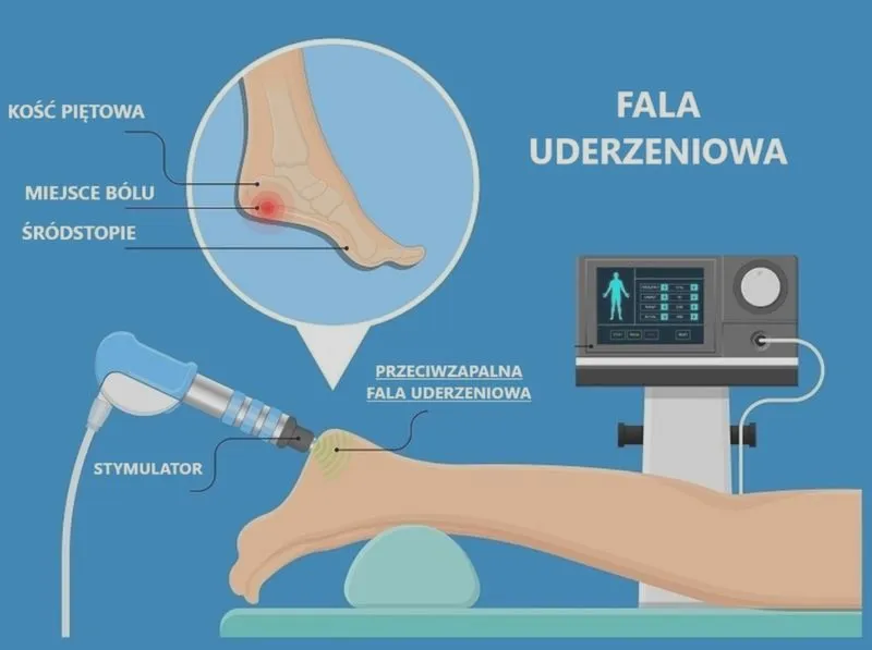 Fala uderzeniowa w rehabilitacji – klucz do skutecznej terapii bólu i regeneracji