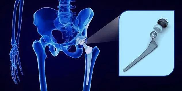 Jak długo trwa rehabilitacja po endoprotezie biodra? Oto, co warto wiedzieć