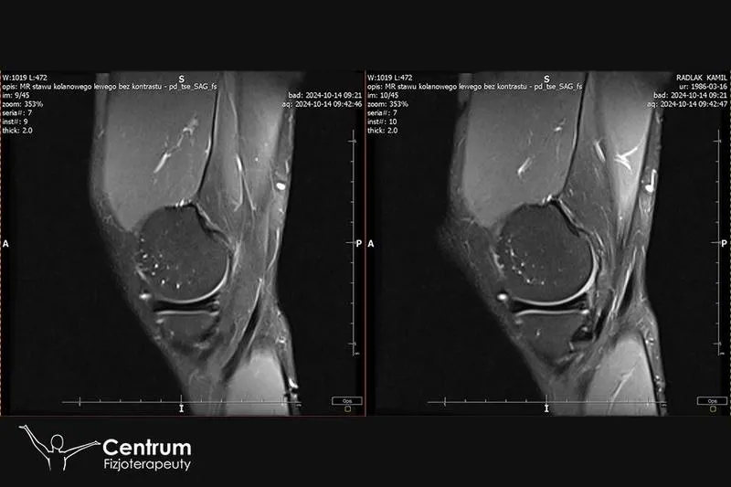 Rehabilitacja łąkotki – ile trwa drogi do pełnej sprawności?
