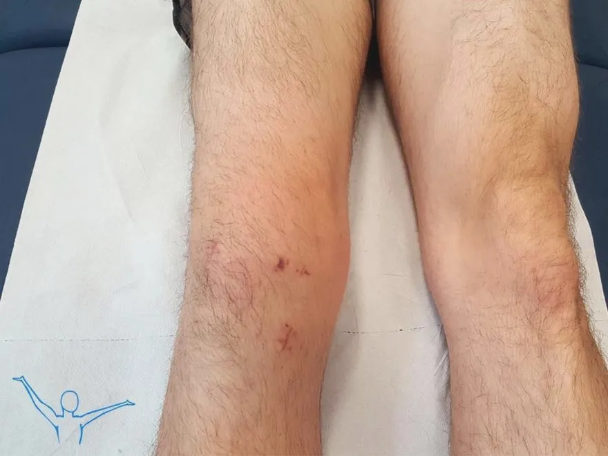 Rehabilitacja po artroskopii – dlaczego jest kluczowa dla Twojego powrotu do sprawności?