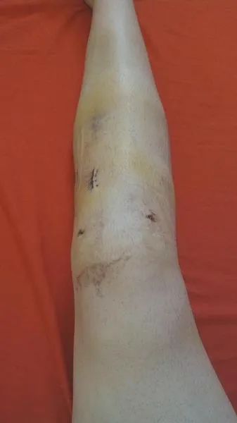 Ćwiczenia w rehabilitacji więzadeł