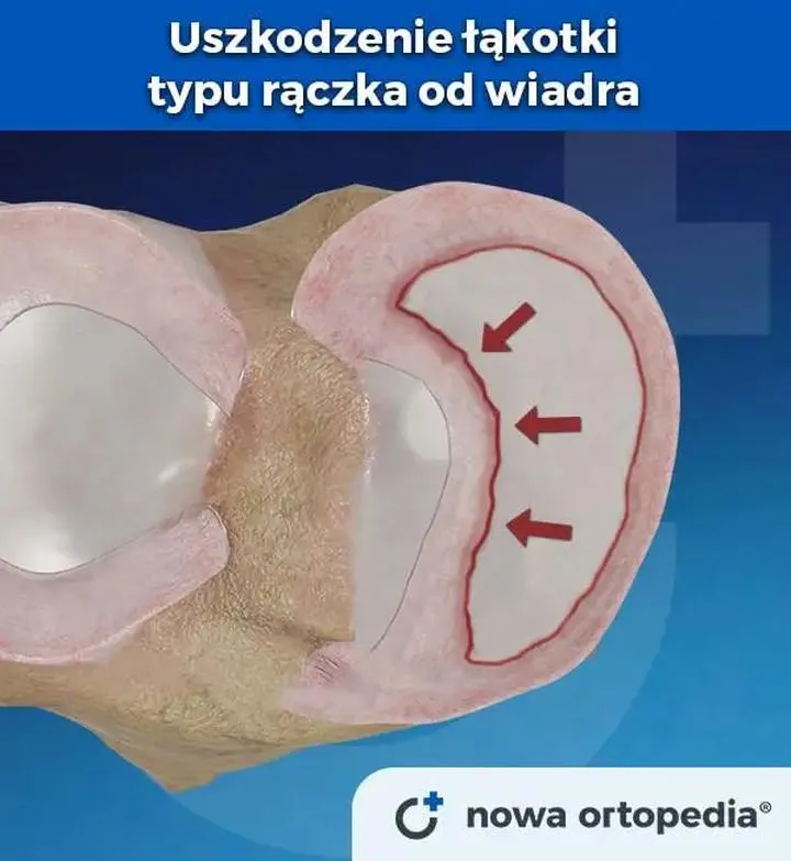 Etapy rehabilitacji łąkotki