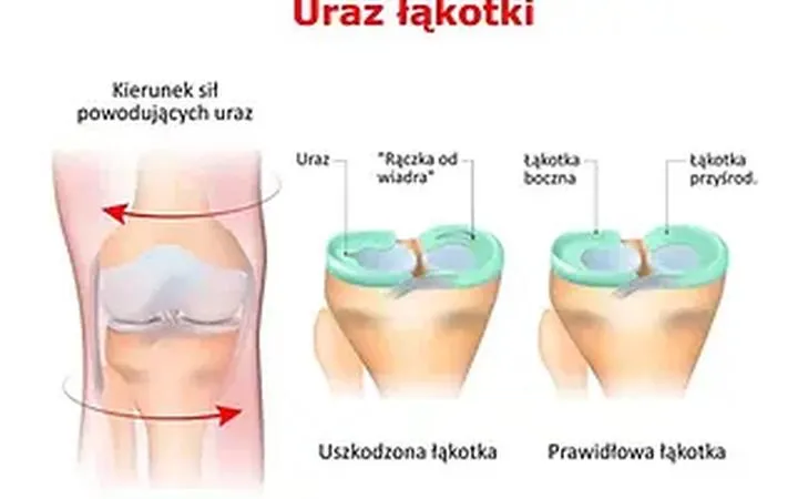 Etapy rehabilitacji łąkotki