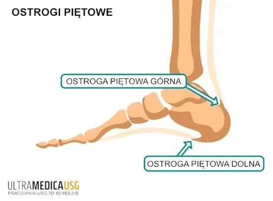Fizjoterapia ostrogi piętowej