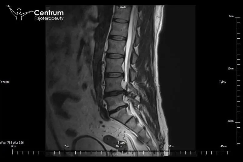 Kiedy operacja przepukliny kręgosłupa