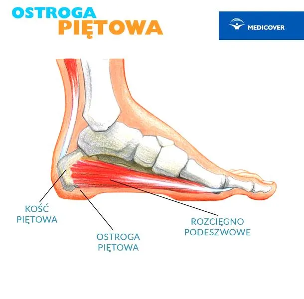Metody leczenia ostrogi piętowej