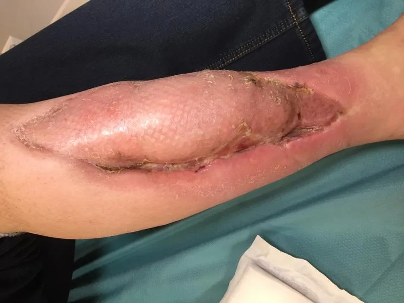 Opinie pacjentów o terapii podciśnieniowej