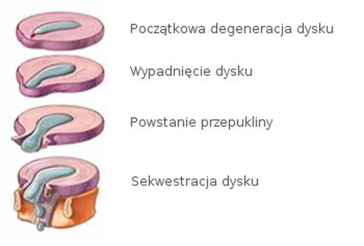 Przepuklina kręgosłupa przyczyny i objawy