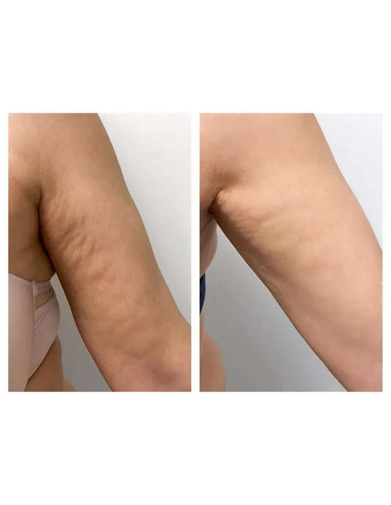 Rehabilitacja falą uderzeniową