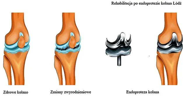 Rehabilitacja kolana