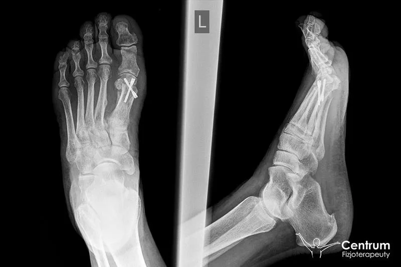 Rehabilitacja po operacji haluksa