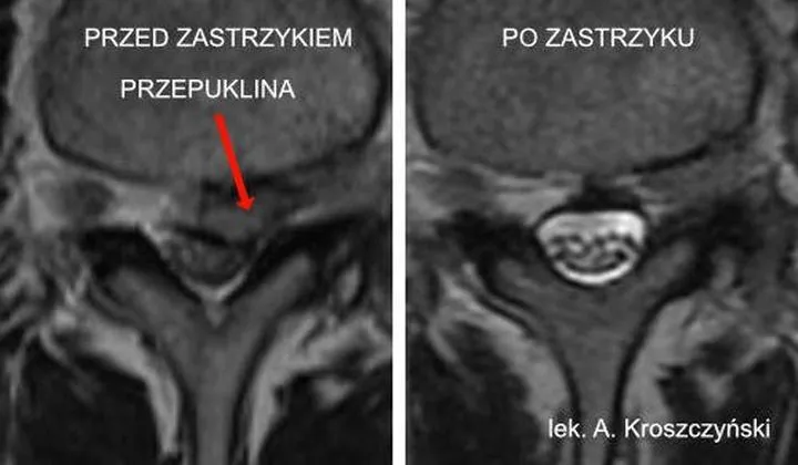 Rehabilitacja po przepuklinie kręgosłupa