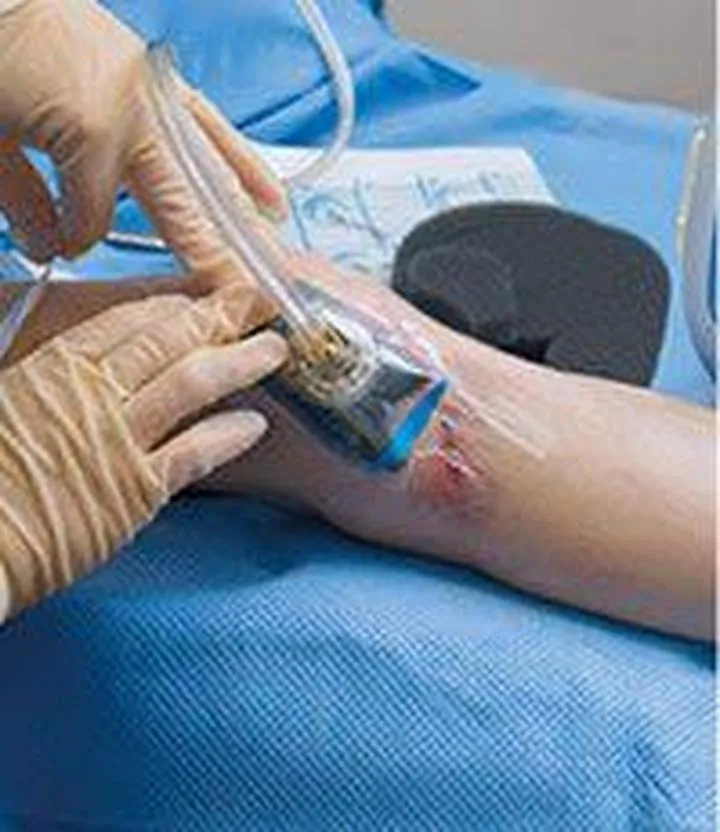 Skuteczność terapii podciśnieniowej