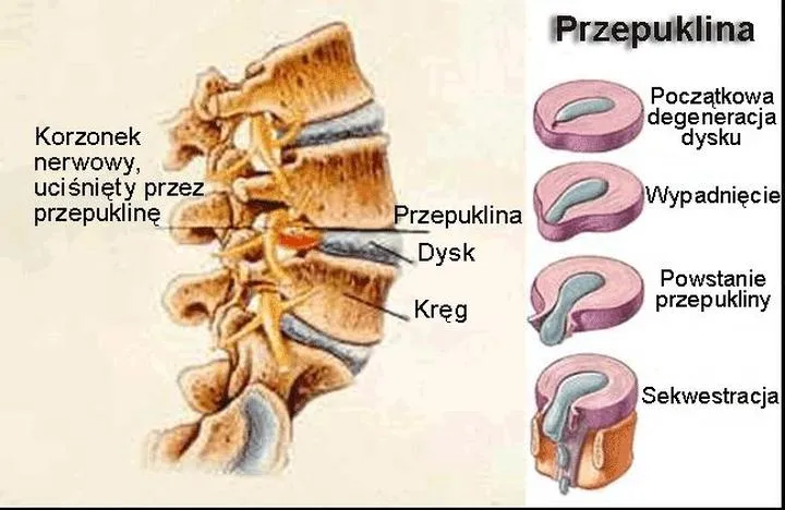 Techniki samopomocy na ból kręgosłupa