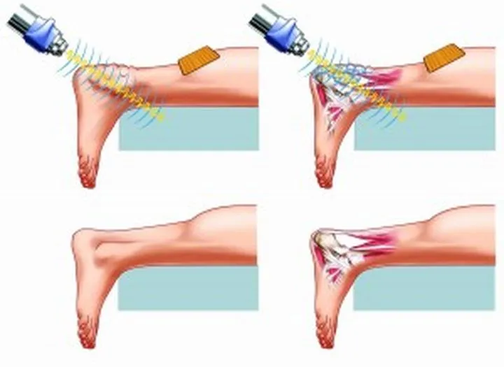 Terapia falami uderzeniowymi